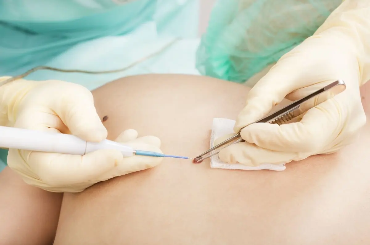 Cyst and Lipoma Minor Surgery