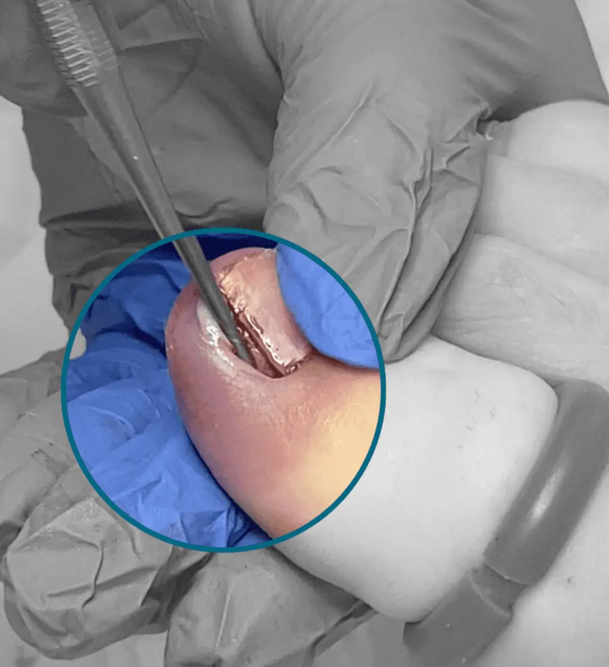 Ingrown Toenail Surgery